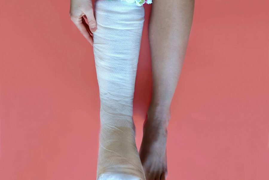 Gesso alla gamba destra mentre sta guarendo dalle ossa rotte.