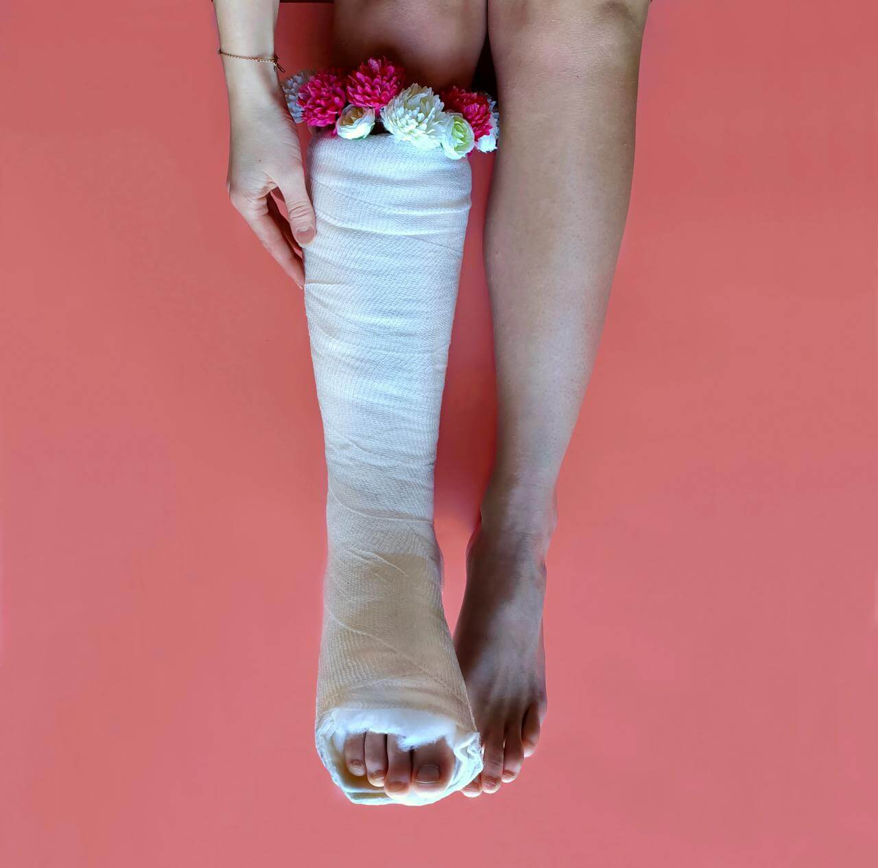 Gesso alla gamba destra mentre sta guarendo dalle ossa rotte.